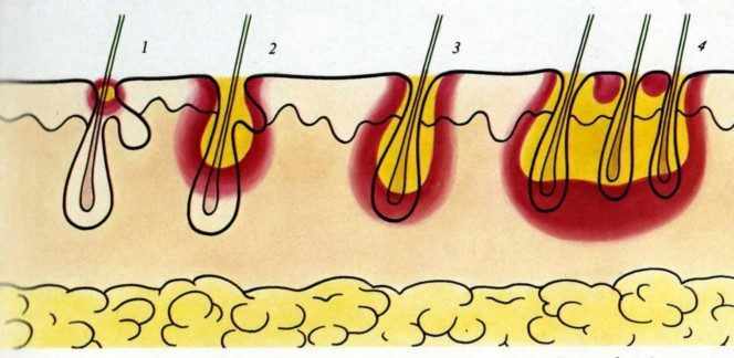 фаза развития фурункула и карбункула