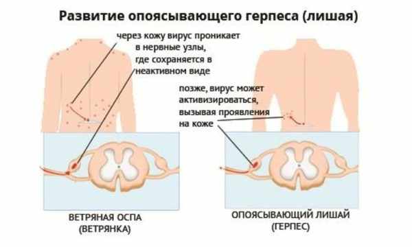 Опоясывающий герпес