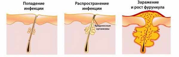 Схема появления фурункула