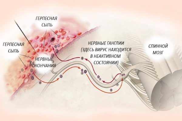 Вирус герпеса в ганглиях