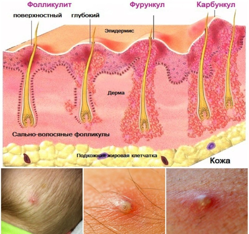 Отличие фурункула от карбункула