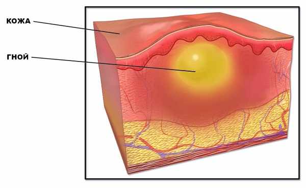 Фурункул
