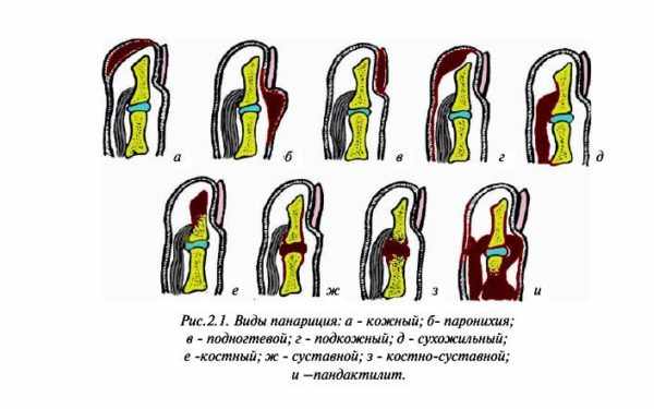 Классификация панарициев