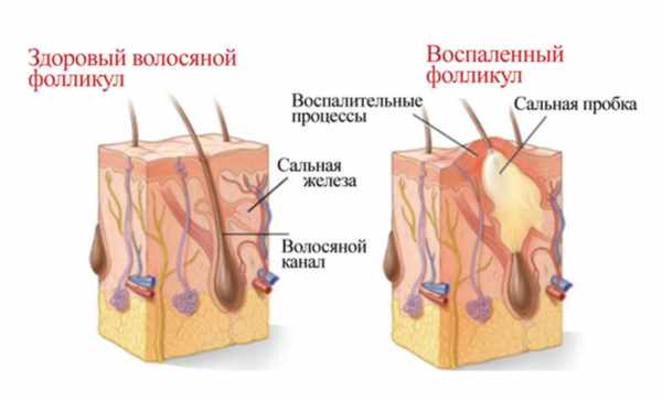 Фолликулит