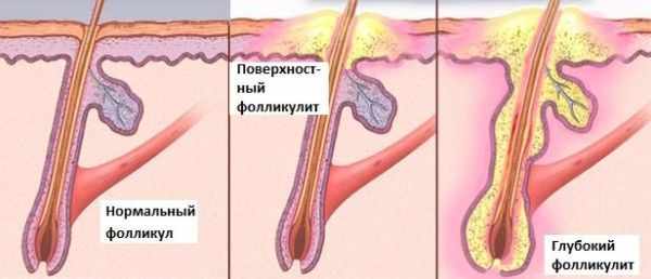 Виды фоликуллита