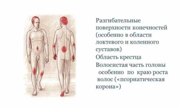 Типичная локализация чешуйчатого лишая