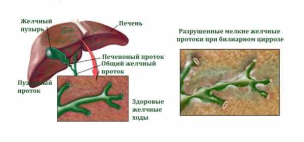 Билиарный цирроз