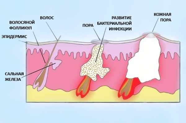 Созревание фурункула