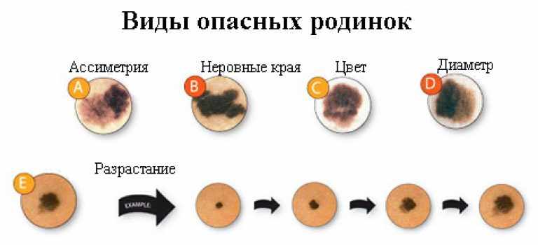 Опасные невусы