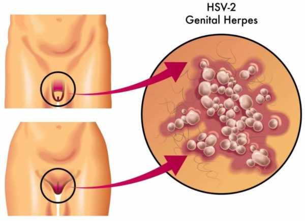 Генитальный герпес