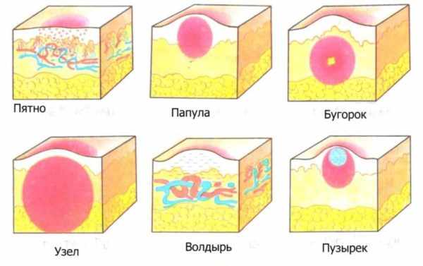 Характеристика высыпаний на лице