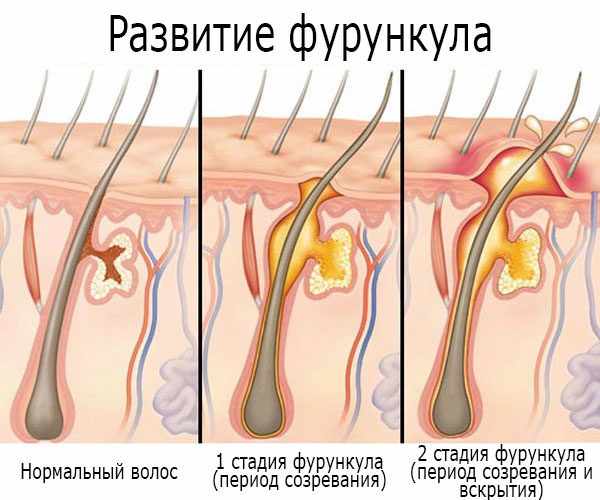 Развитие (стадии) фурункула