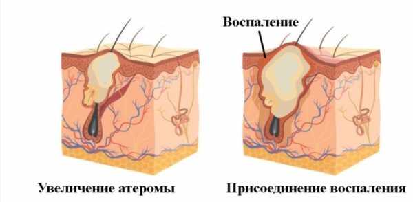 Воспаление атеромы