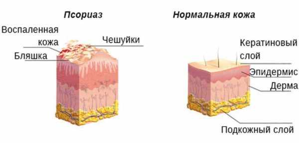 Псориаз