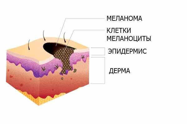 Строение родимого пятна