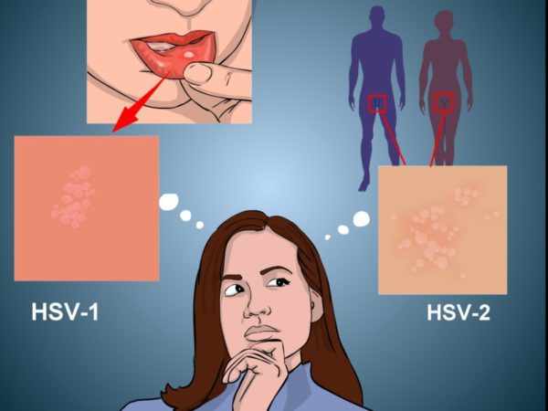 Вирус простого герпеса 1 и 2 типа