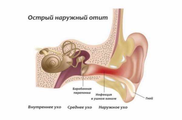 Наружный отит