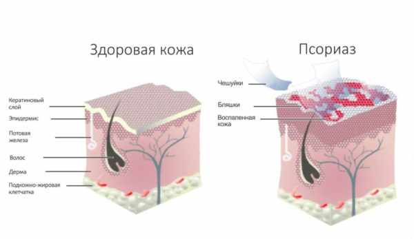 Псориаз