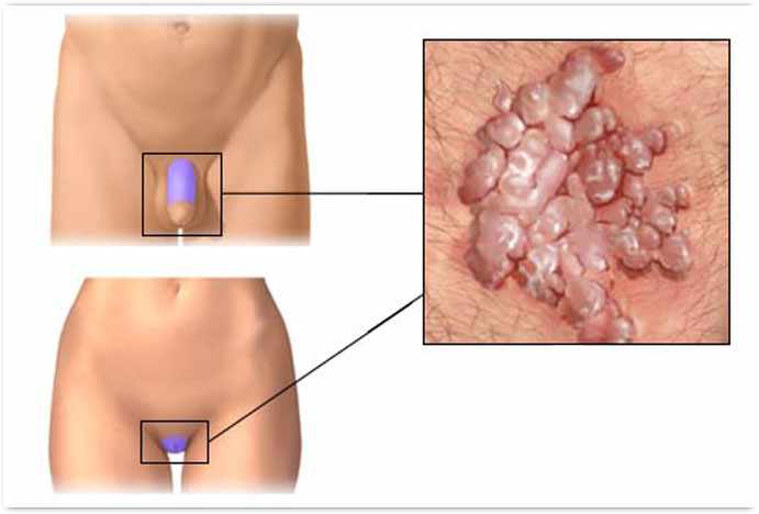 Наросты на половых губах и пенисе