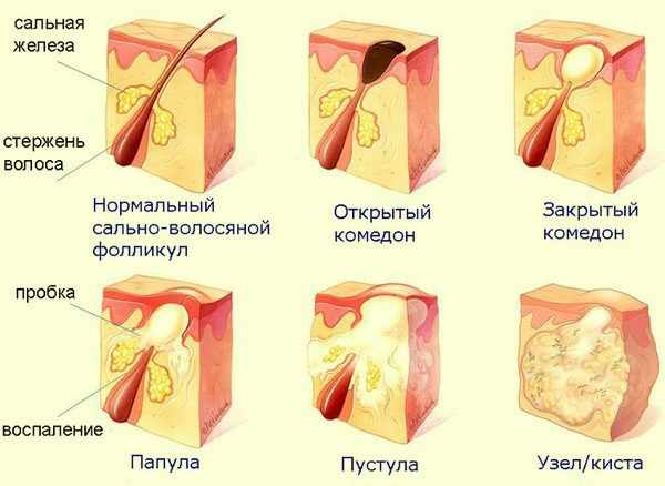 Типы гнойных прыщей