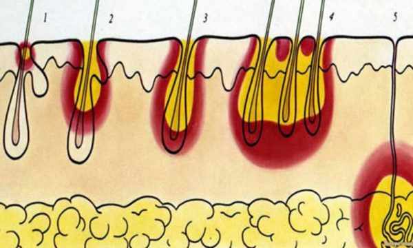 Стадии формирования карбункула