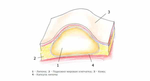 Липома