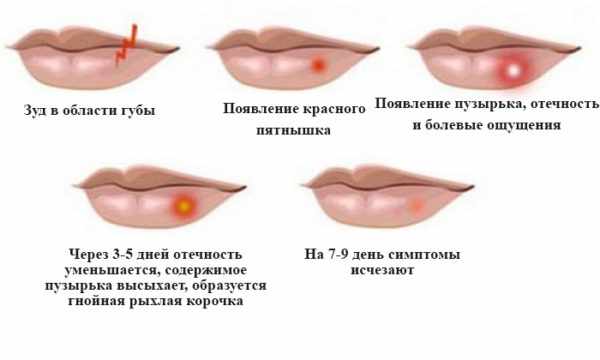 Стадии герпеса на губе