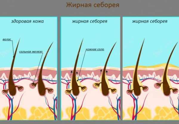 Жирная себорея