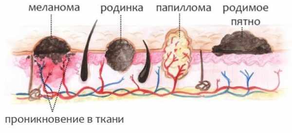 бородавку от других образований