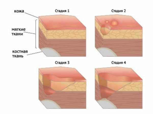 Стадии трофической язвы