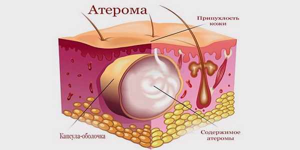 Что собой представляет атерома