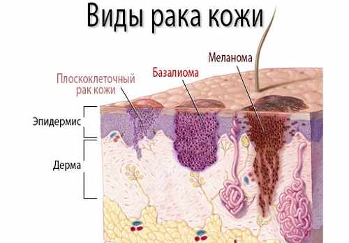 Виды рака кожи