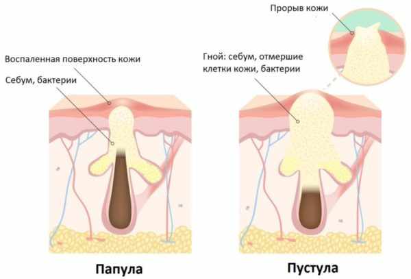 Виды высыпаний