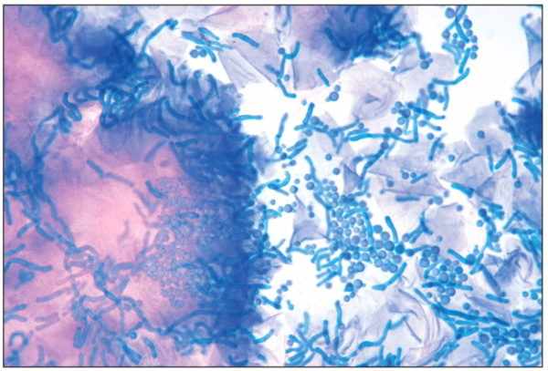 Грибок Pitirosporum ovale под микроскопом