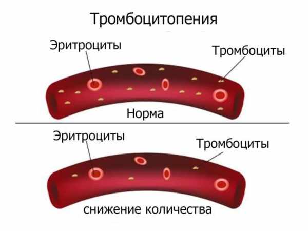 Тромбоцитопения