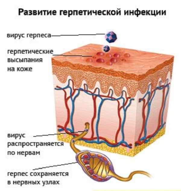 Развитие герпетической инфекции